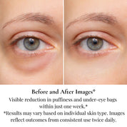 Before and after results showing reduction in dark circles and under eye puffiness with eye treatment