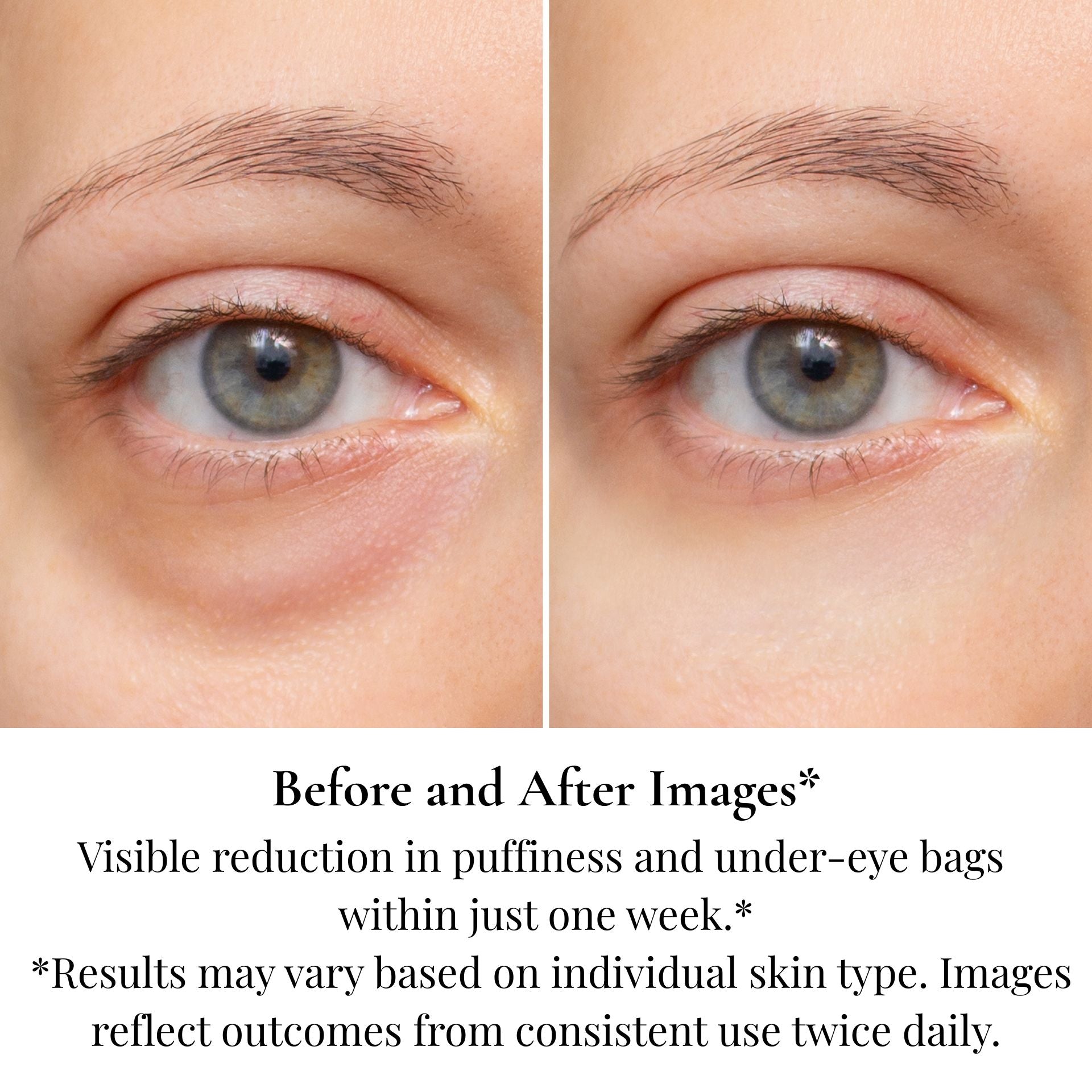 Before and after results showing reduction in dark circles and under eye puffiness with eye treatment